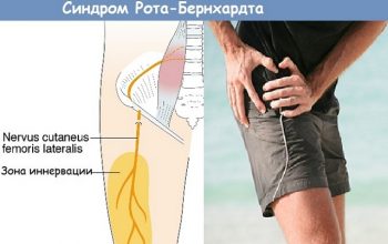 Болезнь Рота симптомы