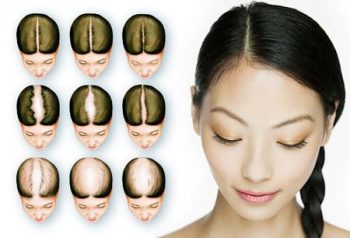 андрогенная алопеция