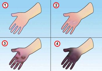 степени обморожения