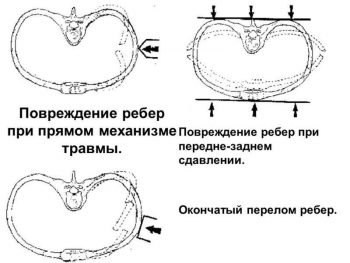механизм переломов ребер