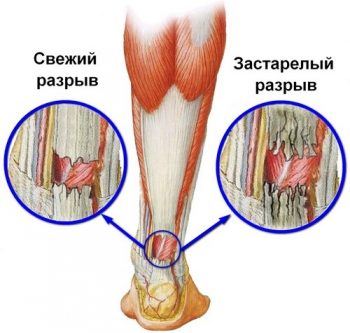 Разрыв ахиллова сухожилия