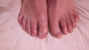 Что делать при отморожении конечности