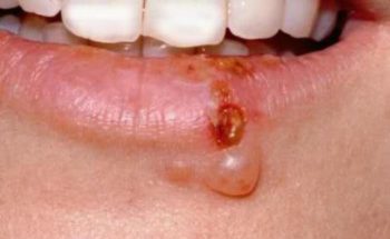 предраковые состояния губы