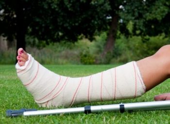 Перелом пяточной кости лечение