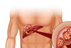 Рак печени: признаки, современные методы лечения