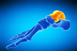 Перелом таранной кости: механизмы травмы, симптомы, лечение