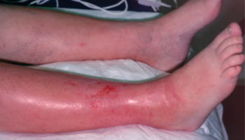 Панникулит что это