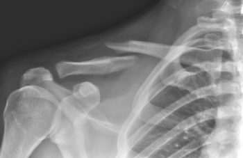 Перелом ключицы со смещением и без симптомы и лечение