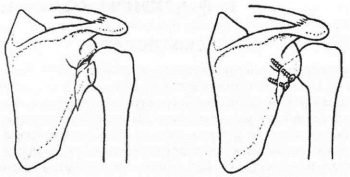 Перелом лопатки остеосинтез