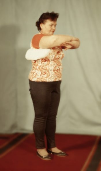 Перелом лопатки симптомы и лечение