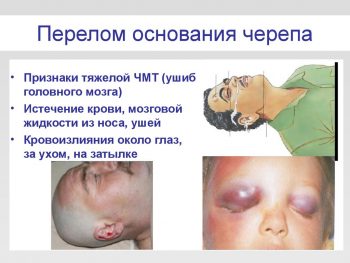 Перелом основания черепа симптомы