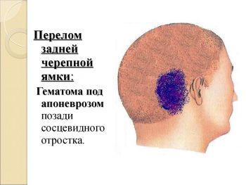 перелом основания черепа