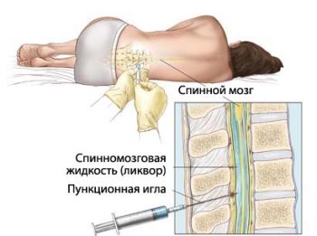 спинномозговая пункция