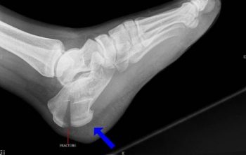 перелом пяточной кости рентгенография