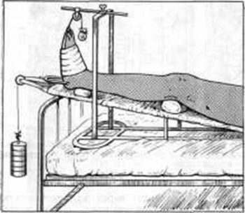 Перелом пяточной кости лечение