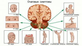 сдавление головного мозга очаговые симптомы