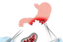 Лейомиома желудка: симптомы, современные методы лечения