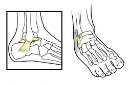 Вывих ноги в районе щиколотки: что делать?