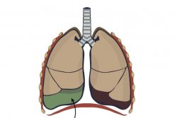 Хилоторакс: причины, симптомы, диагностика, лечение