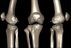 МРТ коленного сустава: что показывает, как проводится, показания