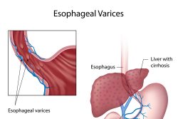 Варикозное расширение вен пищевода