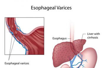 Варикозное расширение вен пищевода