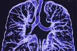 Компьютерная томография легких и бронхов