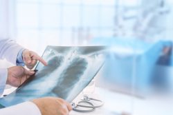 Рентген (рентгенография) органов грудной клетки: показания и противопоказания