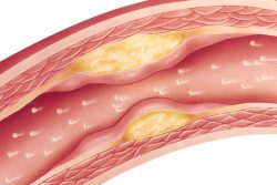 Лечение атеросклероза сосудов нижних конечностей