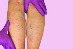 Профилактика варикоза в домашних условиях