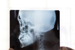 Синдром пустого турецкого седла: причины, симптомы, лечение