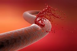 Как остановить кровотечение