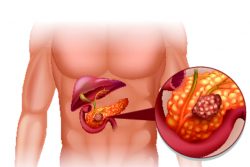Признаки рака поджелудочной железы
