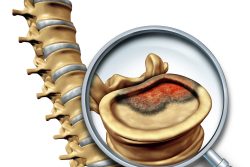 Симптомы рака позвоночника и спинного мозга. Диагностика и лечение