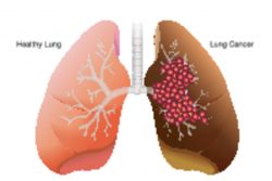 Первые признаки рака легких и их профилактика