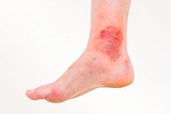 Липоидный некробиоз: причины, симптомы, лечение