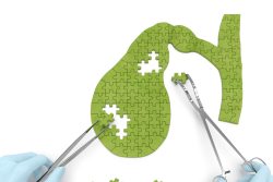 Осложнения острого холецистита