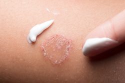 Лечение псориаза в домашних условиях