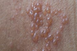 Пузырчатка у взрослых: виды, симптомы, лечение