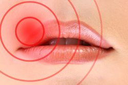 Как лечить герпес на губах