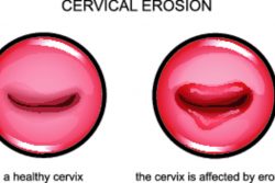 Причины возникновения эрозии шейки матки