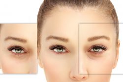 Что такое блефаропластика?