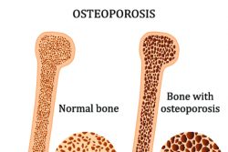 Остеопороз: лечение народными средствами