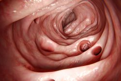 Дивертикулы тонкой кишки: почему возникают, как лечить