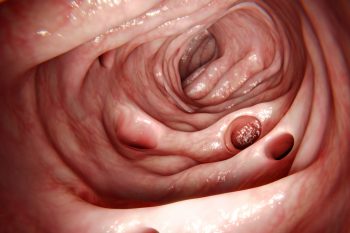 Дивертикулы тонкой кишки: почему возникают, как лечить