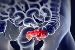 Признаки рака прямой кишки. Симптоматика, диагностика и профилактика