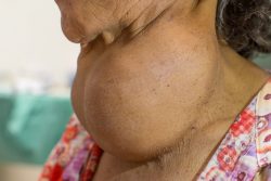 Диффузный токсический зоб: причины, симптомы, принципы лечения