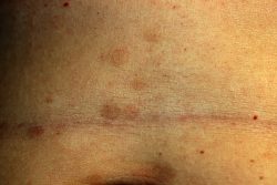 Красный плоский лишай: причины возникновения, методы лечения