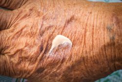 Почему возникает атрофия кожи, виды, симптомы атрофии