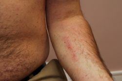 Пигментная крапивница (мастоцитоз): причины появления, симптомы и лечение